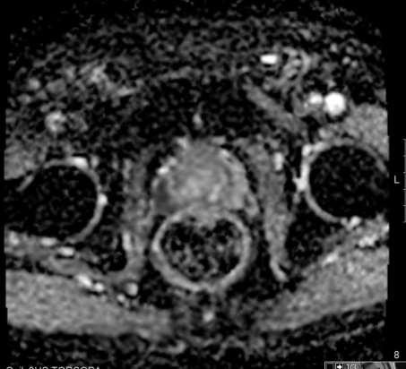 hemorrhagic post-biopsy