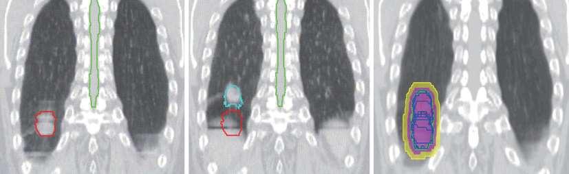 4DCT εικόνες ασθενούς με NSCLC τελοεισπνευστικά (A), τελοεκπνευστικά (B), και σύνθεση από