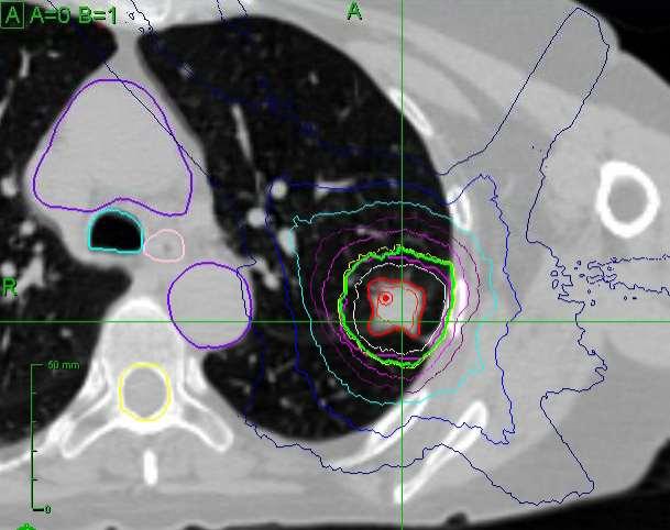 SBRT (SABR) με CK: Ένας άλλος τρόπος να δίνεις 60 Gy Μικρές δέσμες, υψηλής ακρίβειας Πολλαπλές δέσμες Σύμμορφες/Steep