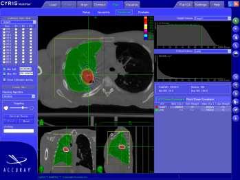 CyberKnife ΣΧΕΔΙΑΣΜΟΣ ΘΕΡΑΠΕΙΑΣ MultiPlan Treatment Planning System