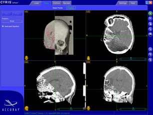 Εισαγωγή δεδομένων ασθενούς CT, MRI, PET Automated and manual image fusion