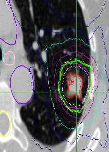Αναμενόμενα αποτελέσματα RTOG 08-13: Phase II Question: How to treat central tumors safely?