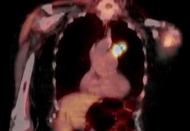 67 F, COPD, pulmonary HTN, ct2an0m0 (4.