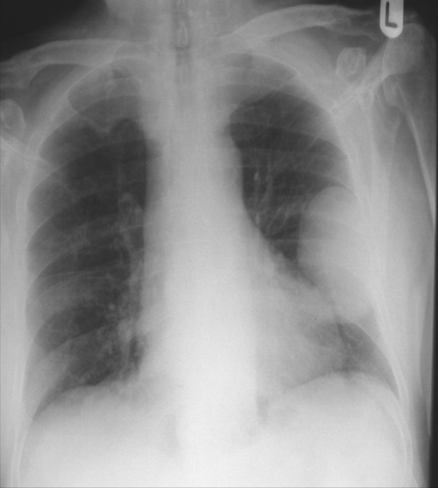 Υπεζωκοτική ή πνευμονική βλάβη; Βλάβη στο αριστερό άνω πνευμονικό πεδίο