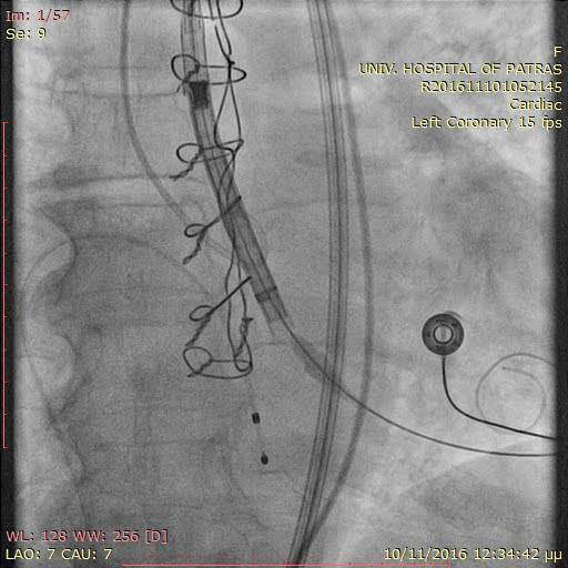 CoreValve 26mm