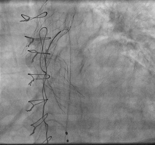 efforts to remove the second valve using En Snare