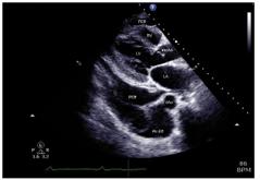 Pericarditis