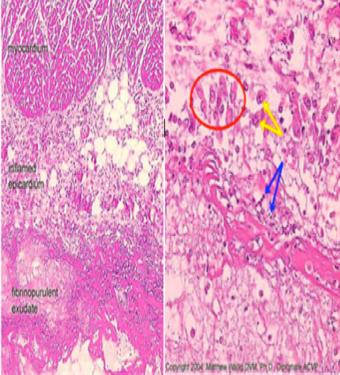 Καρδιοτοξικότητα Από Ακτινοθεραπεία Ιστολογική εικόνα Ινώδεις συµφύσεις, πάχυνση του κολλαγόνου (κυρίως του τοιχωµατικό περικαρδίου) αποτελούν χαρακτηριστικά παραδείγµατα.