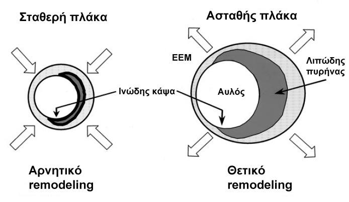 Εικόνα 22. Οι ασταθείς πλάκες εµφανίζουν θετικό remodeling, ενώ οι σταθερές αρνητικό remodeling. Οι ασταθείς πλάκες δεν περιορίζουν τον αυλό και εποµένως δεν προκαλούν στηθάγχη.