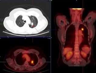 PET-CT μονήρους πνευμονικού όζου 17/4/2014