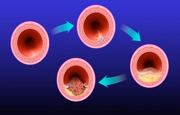 Development of Atherosclerotic Plaques Normal Fatty streak