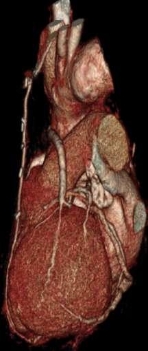 thrombosed portion of the aneurysm.