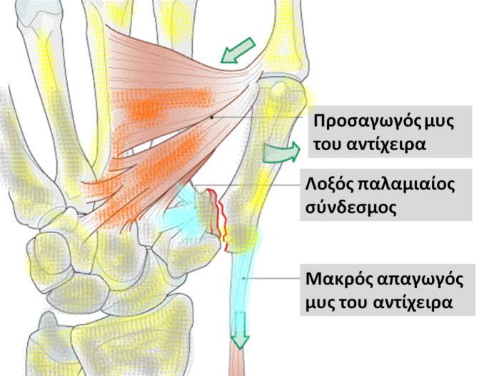 κάταγμα τύπου Τ ή Υ (κάταγμα Rolando), [1]. Το κάταγμα Bennett προκαλείται συνήθως από βία αξονικής συμπίεσης του πρώτου μετακαρπίου, που βρίσκεται σε ελαφρά παλαμιαία κάμψη.