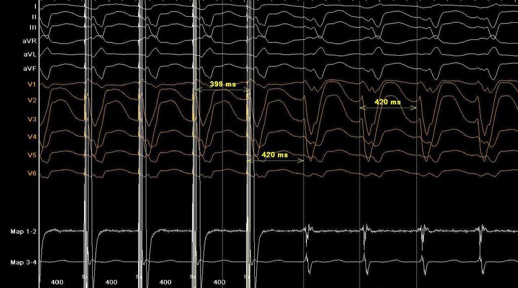 Κιηληθή κνξθνινγία θνηιηαθήο ηαρπθαξδίαο: VT LBBB 420 msec