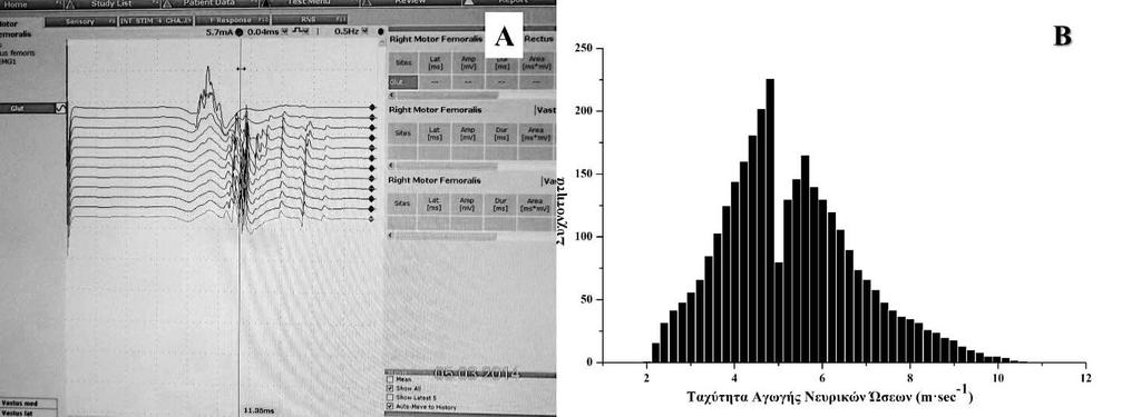 (Α) Καταγραφή των ταυτόσημων και επαναλαμβανόμενων απαντήσεων στα προκλητά δυναμικά και (Β) Κατανομή συχνοτήτων των τιμών της ΤΑ.