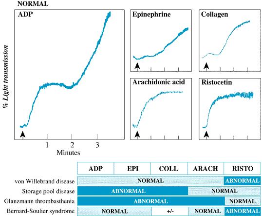 Καμπύλες συσσώρευσης των αιμοπεταλίων ανάλογα με την επίδραση ADP, επινεφρίνη, κολλαγόνο, αραχιδονικό οξύ και