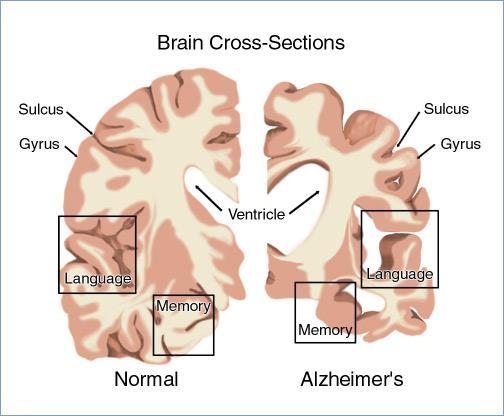 1. ΑΝΑΤΟΜΙΑ ΝΕΥΡΙΚΟΥ ΣΥΣΤΗΜΑΤΟΣ Εικόνα 2. Alzheimer s Brain (Πηγή: Bright Focus Alzheimer) Το νευρικό σύστημα μεταδίδει μηνύματα.