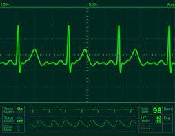 2 Το ηλεκτροκαρδιογράφημα 2.1 Γενικά Το ΗΚΓ καταγράφει την ηλεκτρική δραστηριότητα της καρδιάς, όπου κάθε χτύπος της απεικονίζεται ως μια συγκεκριμένη ηλεκτρική κυματομορφή.