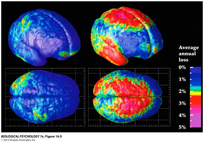 Οι εγκέφαλοι των ασθενών µε σχιζοφρένεια εµφανίζουν δοµικές