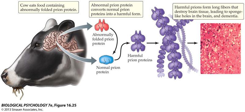 Νόσος Creutzfeldt-Jacobs Infectious proteins (prions) become concentrated in brain tissues, leading to