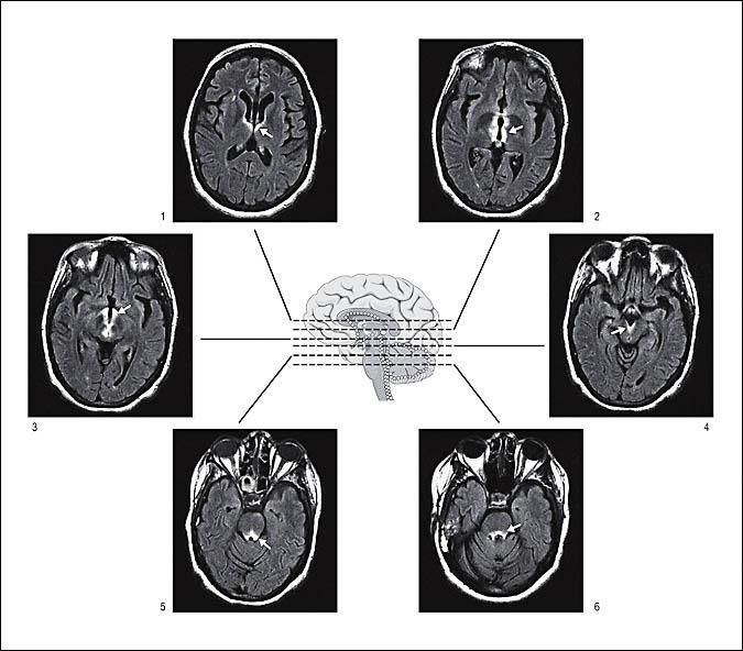 Brain Lessions follow Aqp4