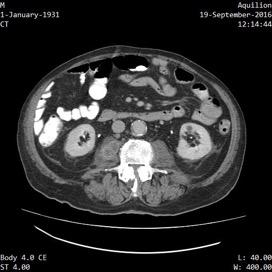 Επάνοδος Σταθεροποίηση Ht ΑΜΚ streptococcus farigius Απύρετος WBC, τριψήφιες ΤΚΕ και CRP Έναρξη moxifloxacin-ceftriaxone