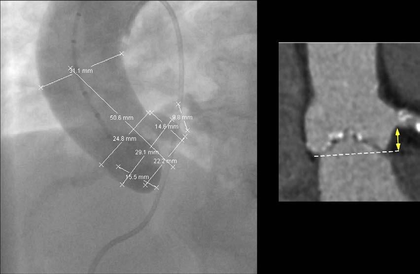 Εικόνα 15. Μέτρηση της απόστασης της έκφυσης των στεφανιαίων από τον αορτικό δακτύλιο με αγγειογραφία και με πολυτομική αξονική στεφανιογραφία με σκιαστικό. 7.5.4 Επιλογή της οδού εμφύτευσης Η αυτοεκπτυσσόμενη CoreValve εμφυτεύεται διαμηριαία ενώ η Edwards SAPIEN μπορεί να εμφυτευθεί και διακορυφαία.