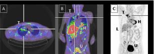 Immuno PET and TKi PET TKi και mabs μπορούν να επιςημανθούν με ραδιονουκλύδια και να χρηςιμοποιηθούν ωσ βιοδεύκτεσ πιθανόσ ανταπόκριςησ ςτην θεραπεύα Χρόςη προσ το παρόν ςε προκλινικό