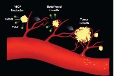 Αγγειογένεζη ζηον καπκίνο ηος πνεύμονα υνδϋεται με τον πολλαπλαςιαςμό του όγκου, την