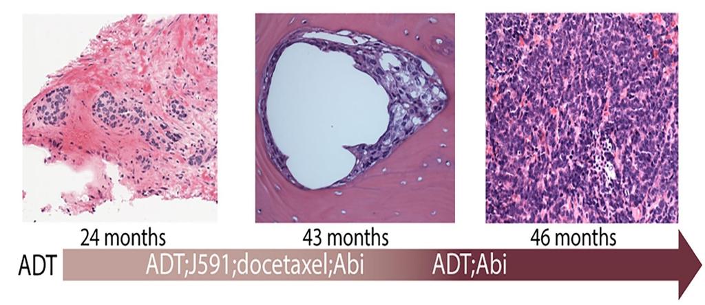 Εξελιξη της ιστολογιας με το χρονο CRPC CRPC NEPC Lymph Node Biopsy Bone biopsy Liver biopsy 80 yo M with metastatic CRPC s/p multiple