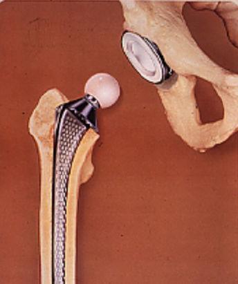 Usađivanjem u kosti, koštano tkivo impregnira poroznu sraslinu i bolje sidri implantant, nego uobičajeni način cementiranja implantanta u kosti( slika 7.2.