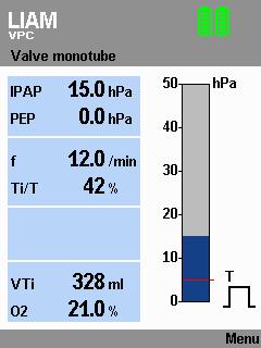 5.10.2 Εκτέλεση Μπορείτε να ενεργοποιήσετε το LIAM χειροκίνητα κατά την αναπνοή. Για αυτό το σκοπό, πατήστε το πλήκτρο.