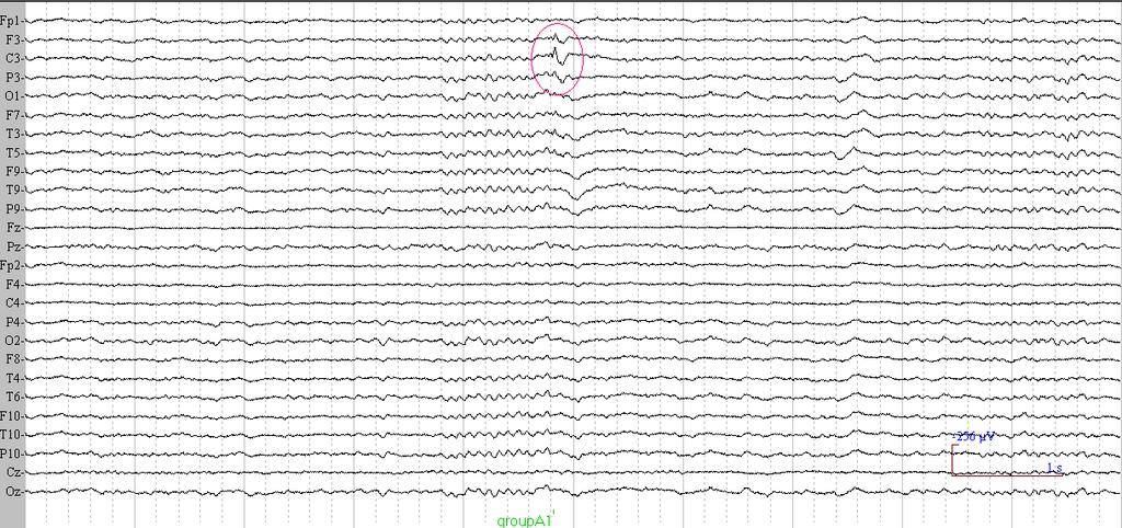 ΟΜΑΔΑ Α1 Μέγιστη αιχμή στο ηλεκτρόδιο C3 με μικρή επέκταση σε F3
