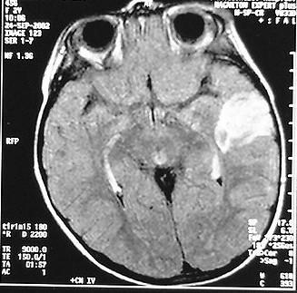 Η απεικονιστική εξέταση MRI στην οποία υπεβλήθει, ανέδειξε χωροτακτική εξεργασία στο μέσο και πλάγιο τμήμα του αριστερού κροταφικού λοβού, καταλαμβάνουσα κυρίως τη μέση και κατώτερη κροταφική έλικα