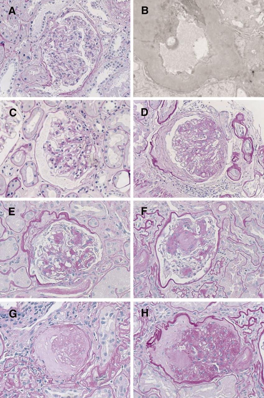 A and B Glomerulus showing only mild ischemic changes C, D Class II glomeruli with mild and moderate mesangial expansion,
