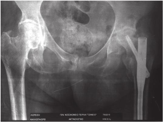 Late onset Avascular Necrosis of the femoral head after a healed intertrochanteric fracture treated with Gamma nail A case report and review of literature 107 Figure 3.