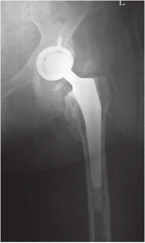 This often leads to hip instability. With the loss of the greater trochanter attachment to the femur, there is a loss of abductor power and hip compressive forces.