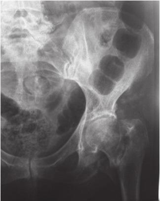 106 E.E.X.O.T., Volume 67, Volume 3, 2016 Figure 1. Basocervical, 3 part intertrochanteric fracture of the left femur Figure 2.