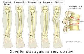 ΣΥΝΗΘΗ ΚΑΤΑΓΜΑΤΑ ΟΣΤΩΝ Κάταγμα Χλωρού ξύλου= παρατηρείται σε μικρά παιδιά. Το κάταγμα αφορά το κυρίως οστό, ενώ το περιόστεο μένει ανέπαφο.