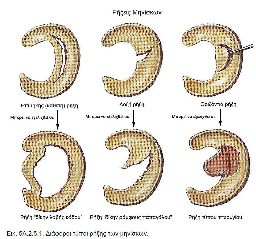 Επιμήκεις. Αρχίζουν από το οπίσθιο τμήμα του μηνίσκου και μπορεί να επεκταθεί σε όλο το μήκος του μηνίσκου. Σε αυτήν την περίπτωση ο μηνίσκος χωρίζεται σε δύο τμήματα, το έσω και το έξω.