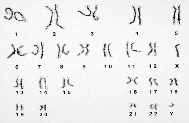 27 BRCA γονίδια BRCA1 (17q21) 19941 BRCA2 (13q12) 19952 υχνότητα: 1/500-1/800 (0.