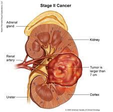 νεφροκυτταρικό καρκίνωµα 85% των όγκων του νεφρού Μ. Ο.