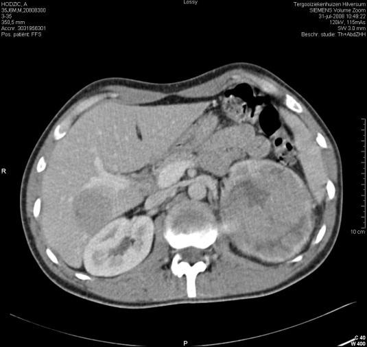 Response of the Primary Tumor to Neoadjuvant Sunitinib in Patients With