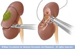 νεφρού 1. Ανοιχτή ριζική νεφρεκτομή 2.