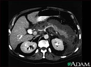 CT Scan of acute