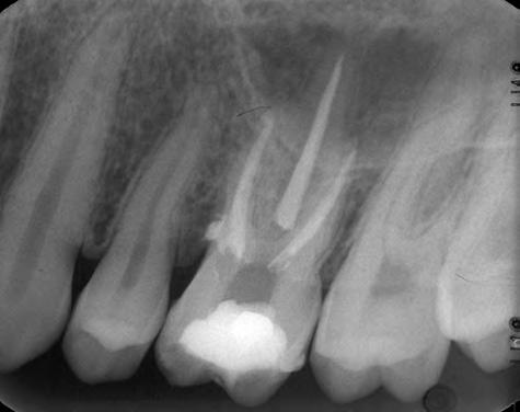 Στο πανοραμικό ακτινογράφημα δεν παρατηρήθηκε παρόμοια βλάβη σε κάποιο άλλο δόντι. Με χρήση περιοδοντικής μήλης δεν διαπιστώθηκε επικοινωνία της βλάβης με Εικόνα 1. Αρχική ακτινογραφία.