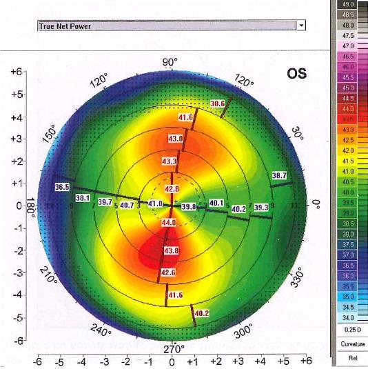 Χάρτης πραγματικά καθαρής δύναμης (TRUE NET POWER MAP) Ο χάρτης της πραγματικά καθαρής δύναμης (Εικόνα 7.2) υπολογίει την πραγματική οπτική λειτουργία ολόκληρου του κερατοειδούς.