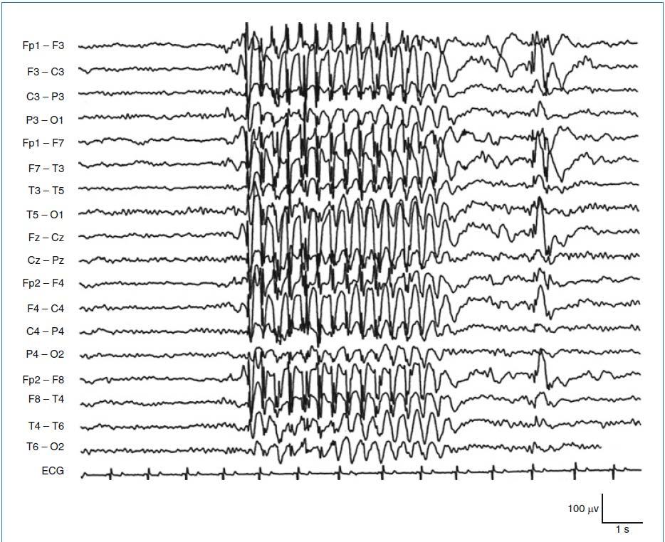 Ασθενής με IGE Εστιακές μετωπιαίες ΕπΕκφ, λίγα msecs μετά μια αφαιρετική κρίση