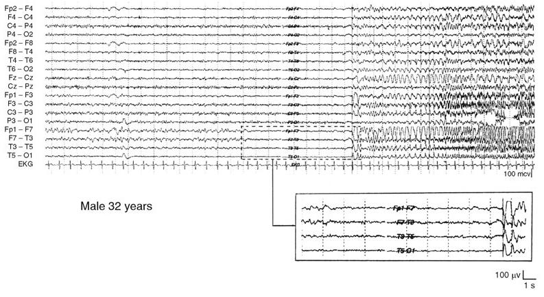 Τυπικό Κρισικό ΗΕΓ Έσω Κροταφικού Λοβού (Engel et al. 2008) «Επιπέδωση» των ρυθμών στις πρόσθιες κροταφικές απαγωγές.