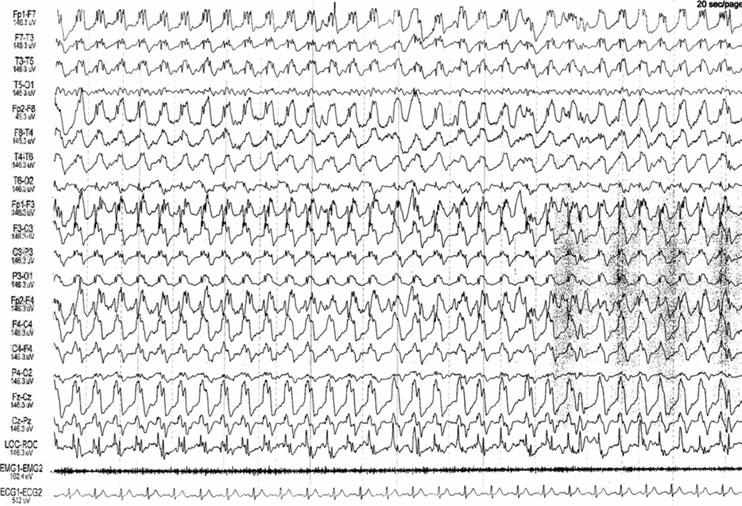 De novo αφαιρετικό SE στην όψιμης έναρξης De novo absence status epilepticus of late onset Εκδηλώνεται σε ενήλικες με πιθανό ιστορικό IGE ή μετά απόσυρση από αλκοόλ ή ψυχοτρόπα φάρμακα.